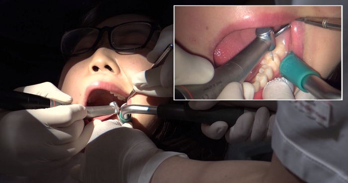 歯フェチ！本物歯科治療映像 約10年ぶりの治療に麻酔無しで挑むが…安田ななは49