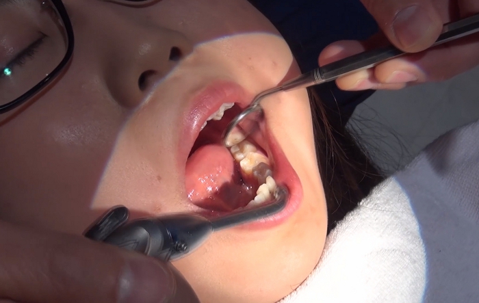 歯フェチ！本物歯科治療映像 約10年ぶりの治療に麻酔無しで挑むが…安田ななは47